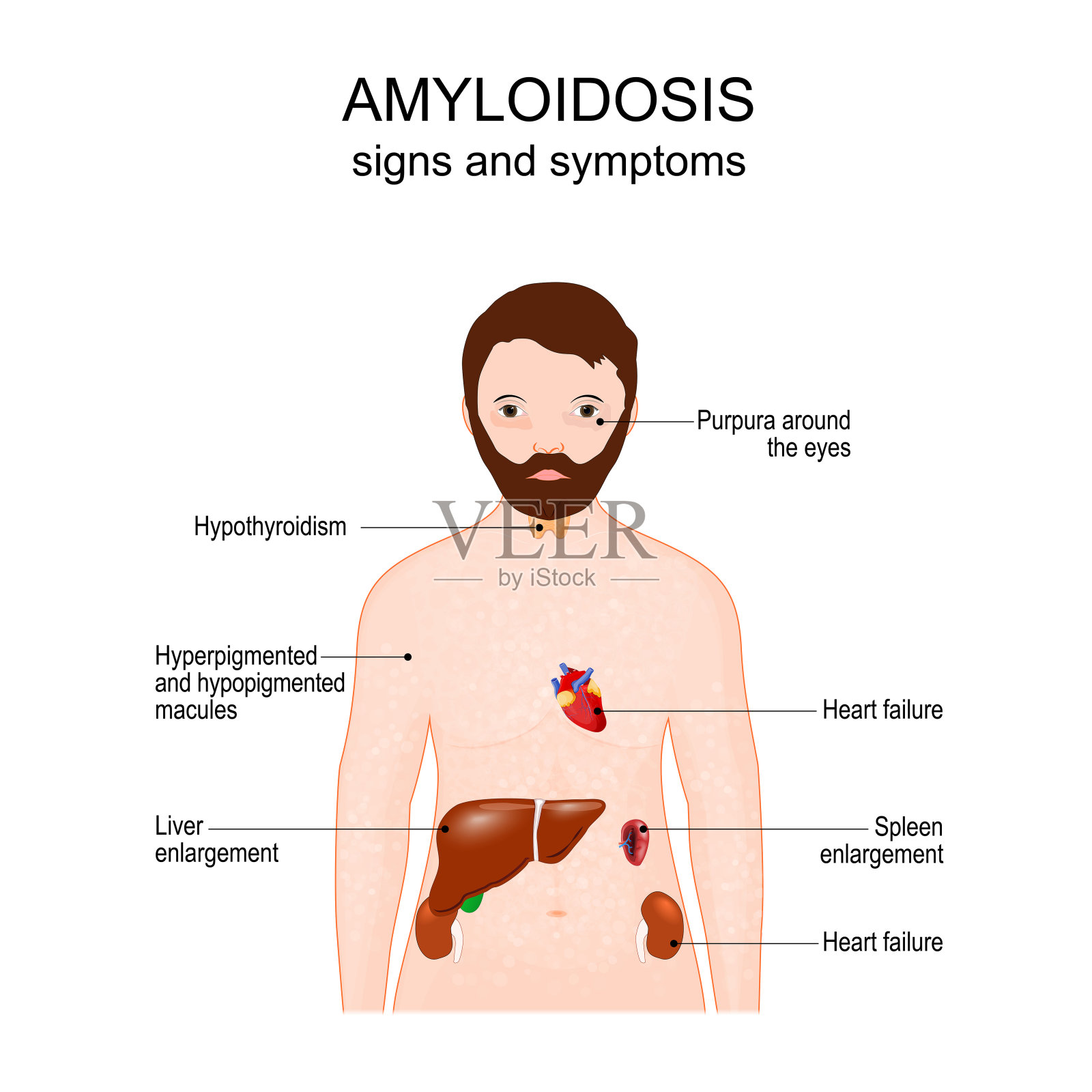 淀粉样变的症状插画图片素材