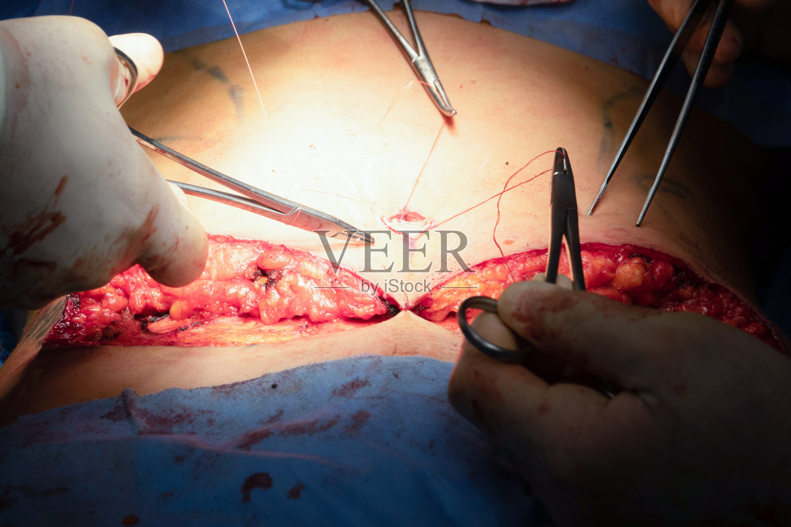 在手术室做腹部成形术照片摄影图片