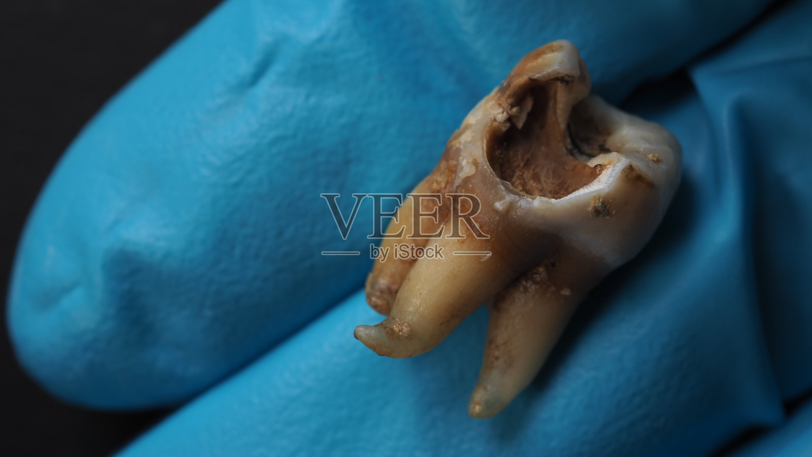 蛀牙和牙医手手套和黑色背景。牙科医生拔牙后的蛀牙至牙根的微距照片。真实的牙齿解剖，由于缺乏牙齿护理。龋齿俯视图照片摄影图片