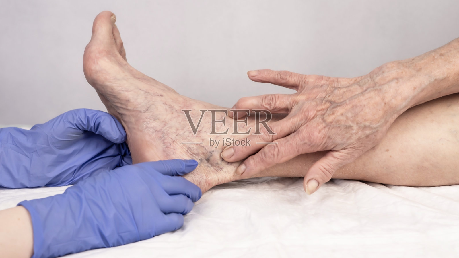 静脉曲张。腿上有蜘蛛静脉，用硬化疗法治疗。硬化疗法。照片摄影图片