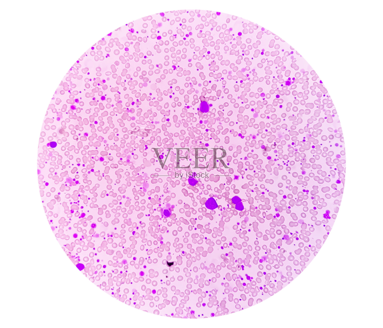 慢性髓系白血病(CML)加速期伴血小板增多。慢性骨髓性白血病。照片摄影图片