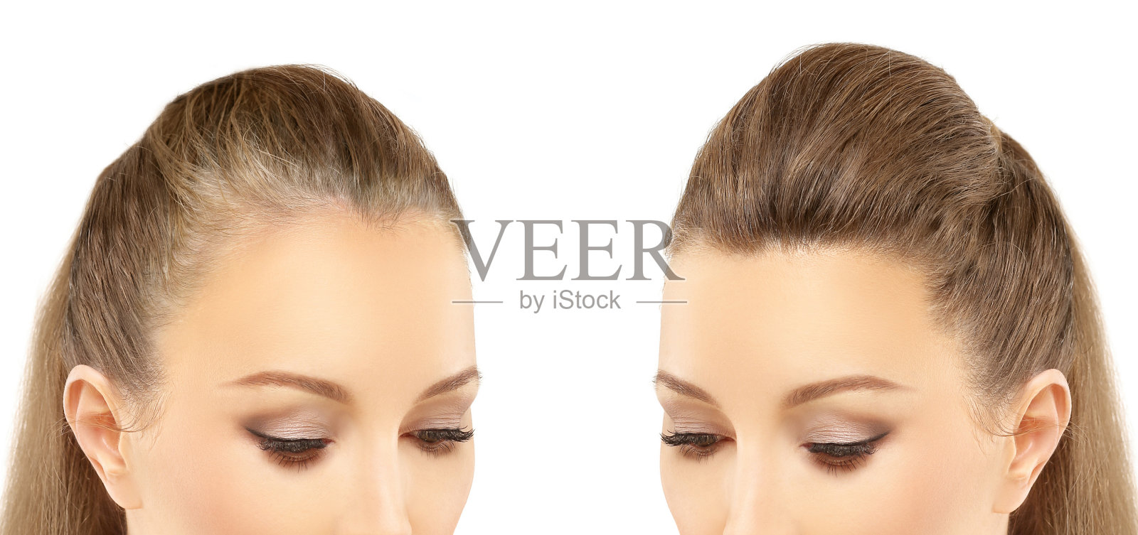 斑秃，女性型秃顶，脱发治疗，植发，植发手术照片摄影图片