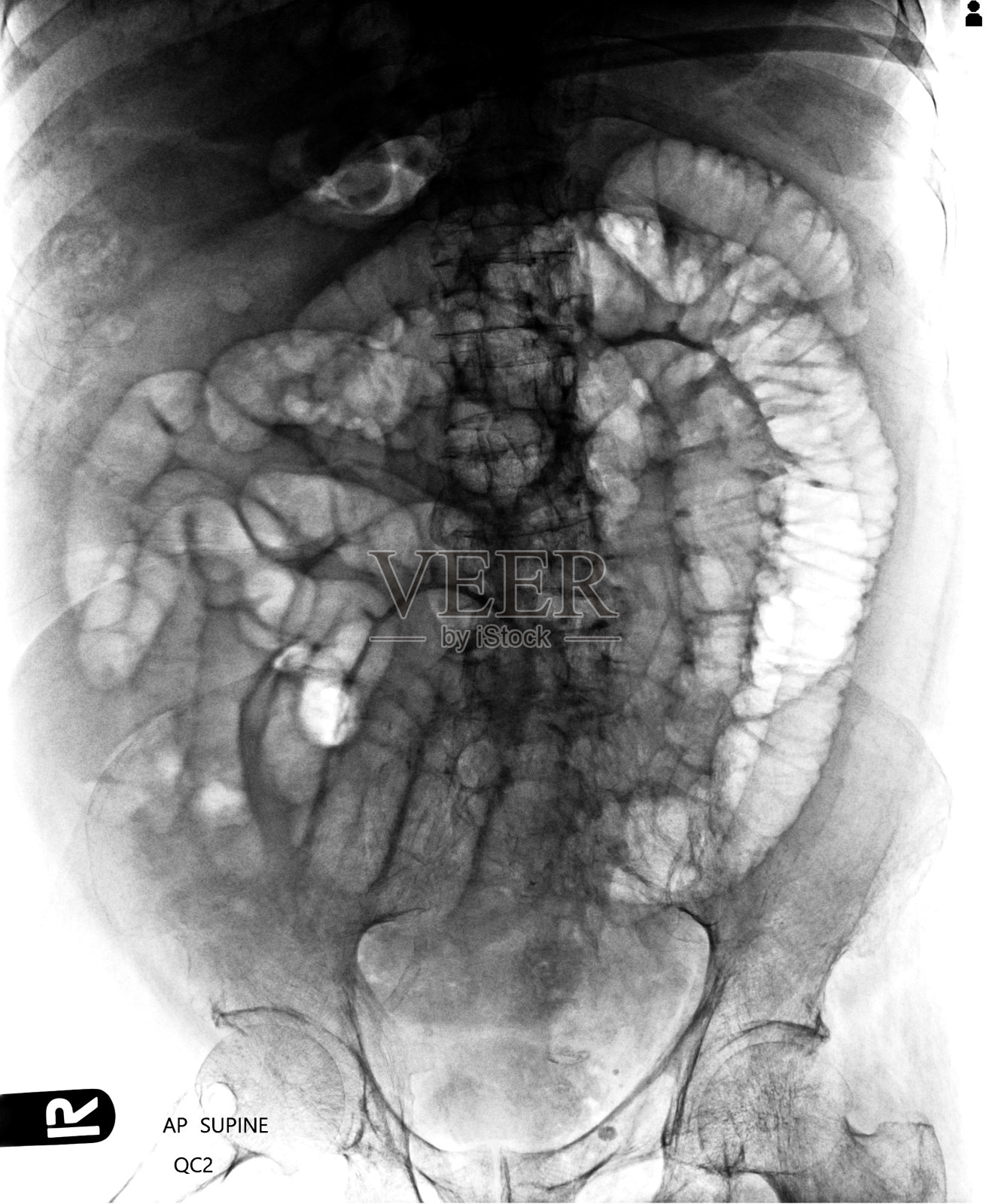x线腹部AP病例腹水照片摄影图片