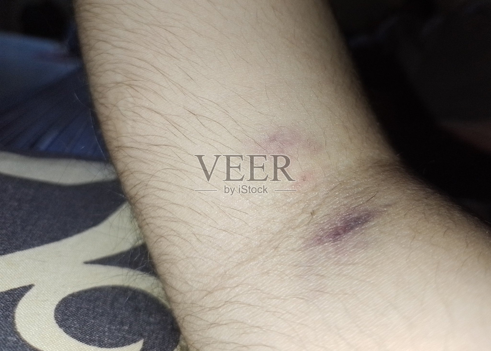 瘀伤照片摄影图片