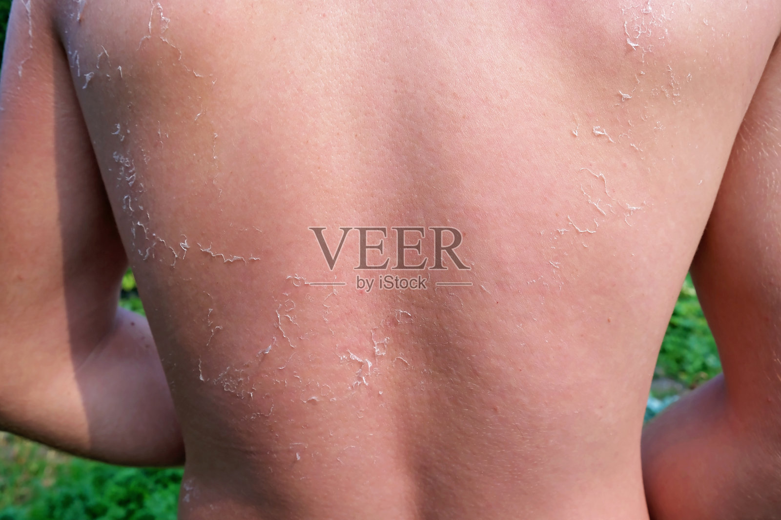 那人在海边晒伤了。皮剥落了。保护皮肤免受日晒。照片摄影图片