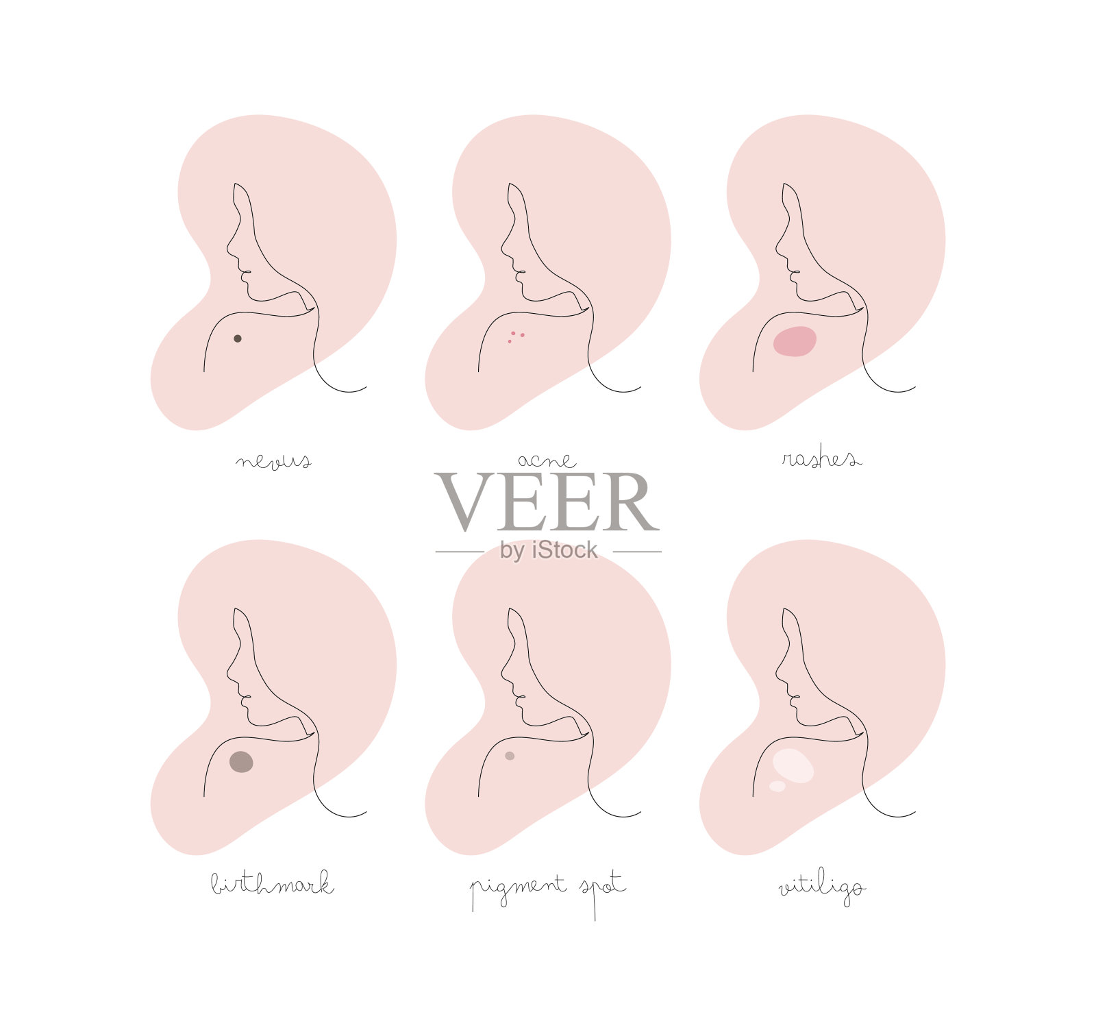 皮肤类型信息图。矢量一行现代插图集。女性面部头像以痤疮、皱纹、色素沉着、皮疹、胎记、白癜风等颜色符号隔离在白色上。护肤设计插画图片素材