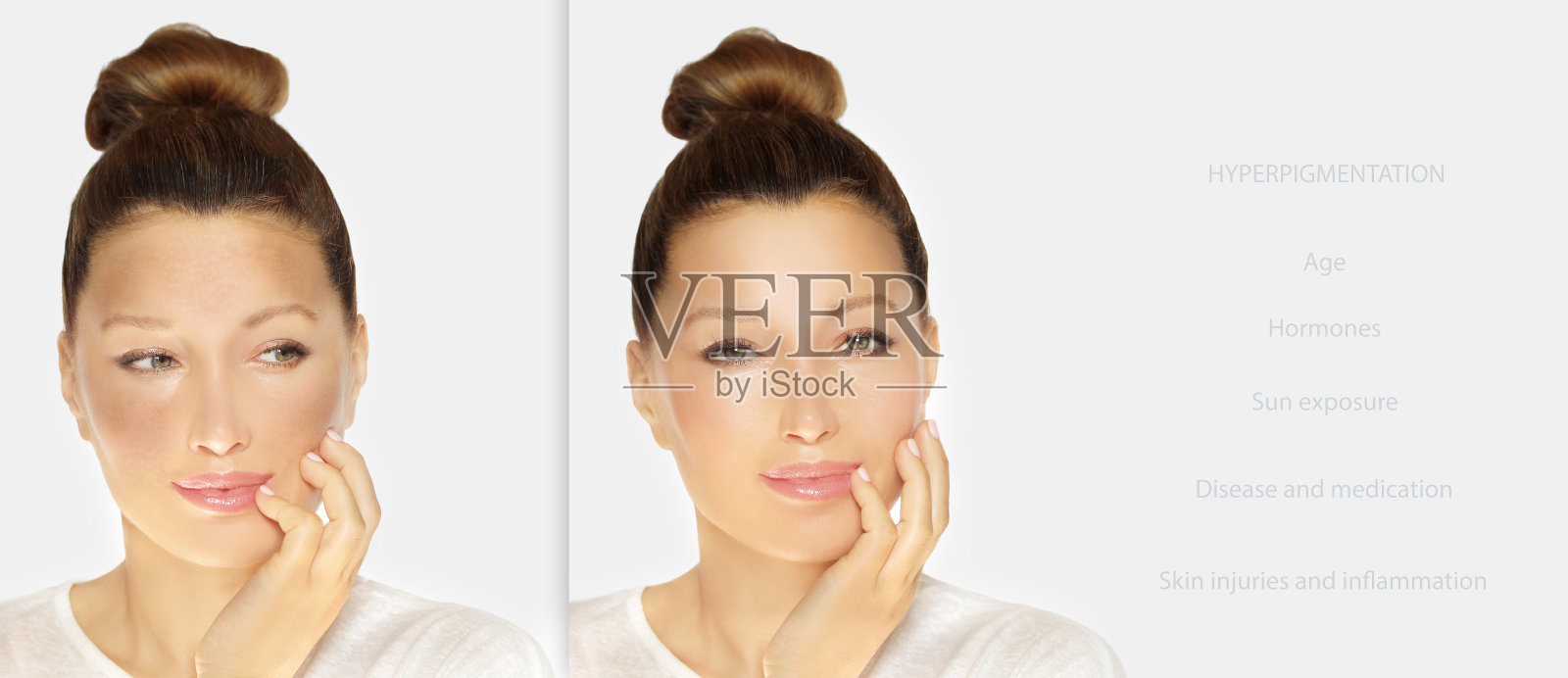 黑斑，雀斑，色素沉着(黄褐斑或黄褐斑)，概念-皮肤提亮，皮肤美白，果酸，AHA，皮肤提亮照片摄影图片