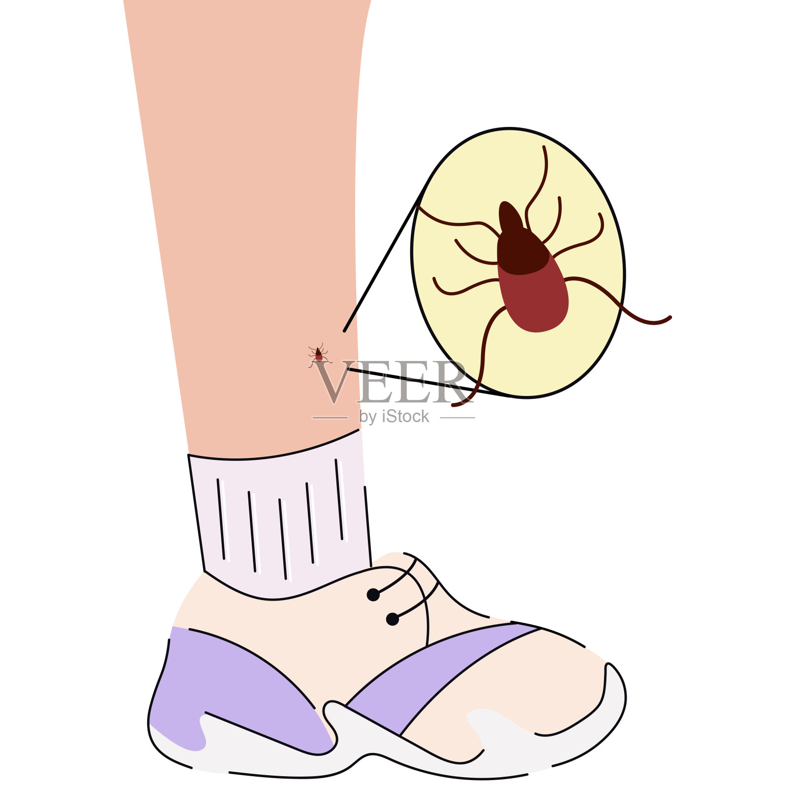 被蜱虫叮咬的人腿。蜱虫咬腿。蜱虫咬人。医疗插图。插画图片素材