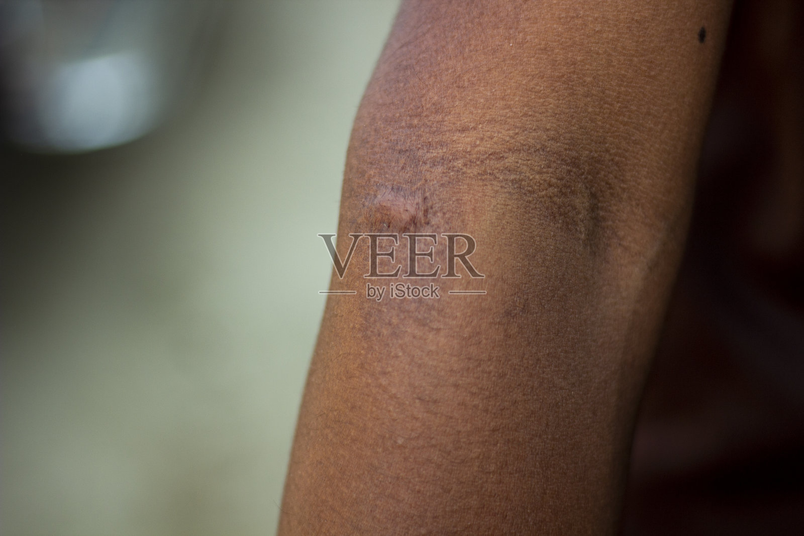 人类皮肤上的一个疙瘩和背景模糊照片摄影图片