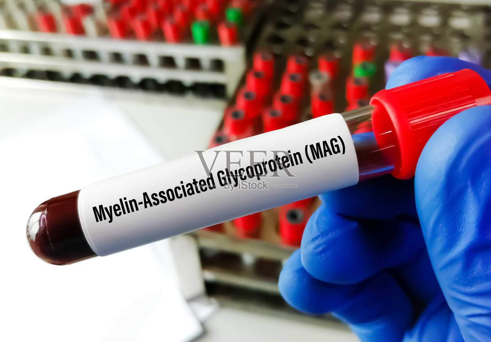 髓磷脂相关糖蛋白(MAG)血检诊断自身免疫性周围神经病变单克隆丙种球蛋白病。照片摄影图片