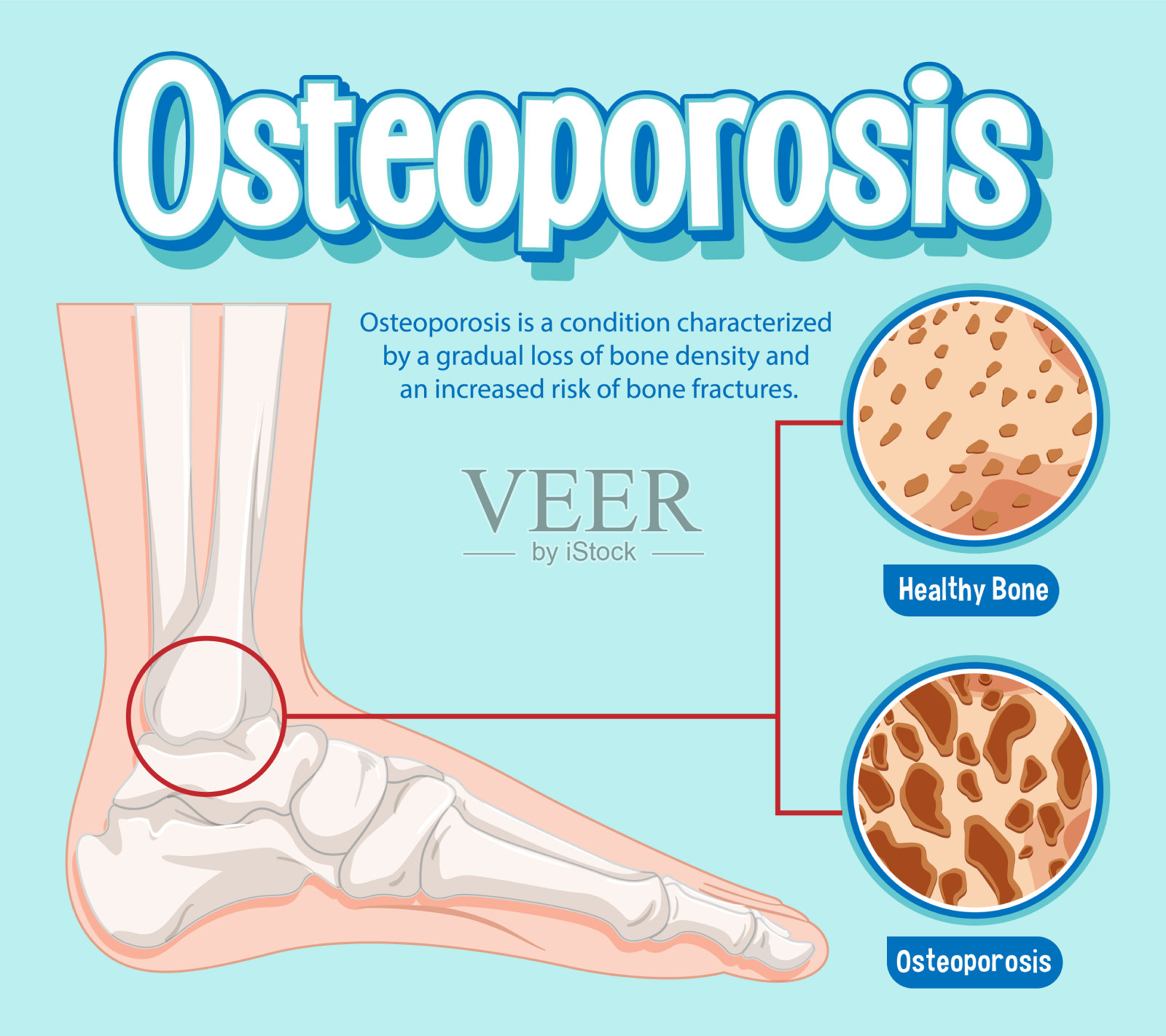 骨质疏松症的宣传海报插画图片素材