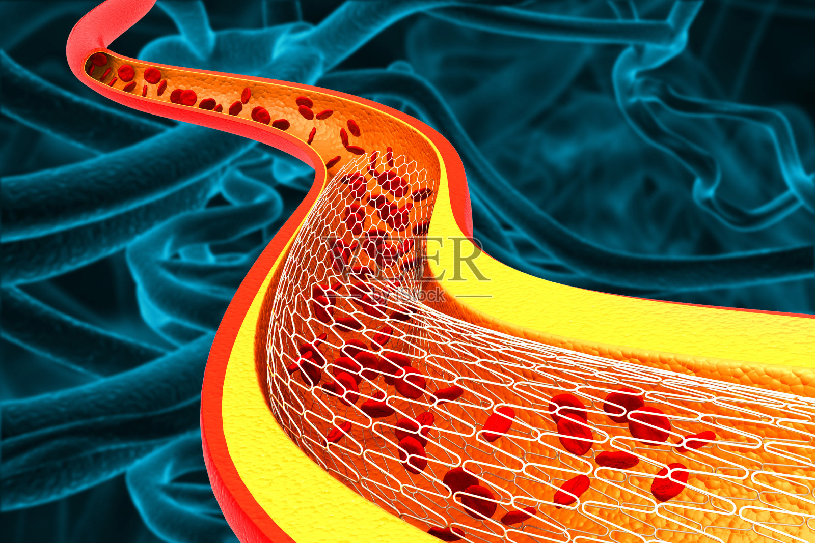 球囊血管成形术支架。三维演示照片摄影图片