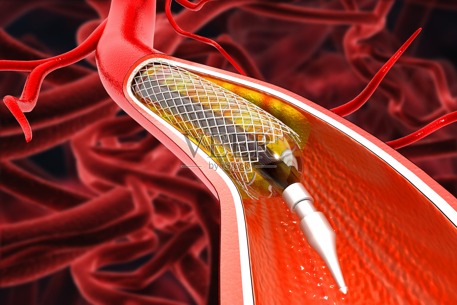 支架血管成形术的科学背景。三维演示照片摄影图片
