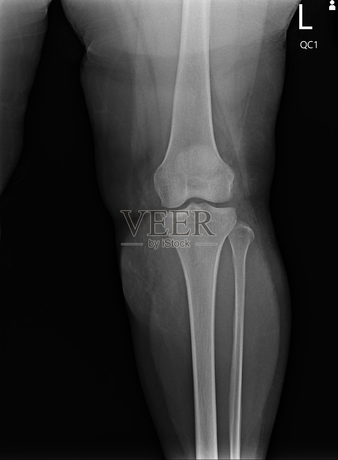 x光片显示膝关节解剖照片摄影图片