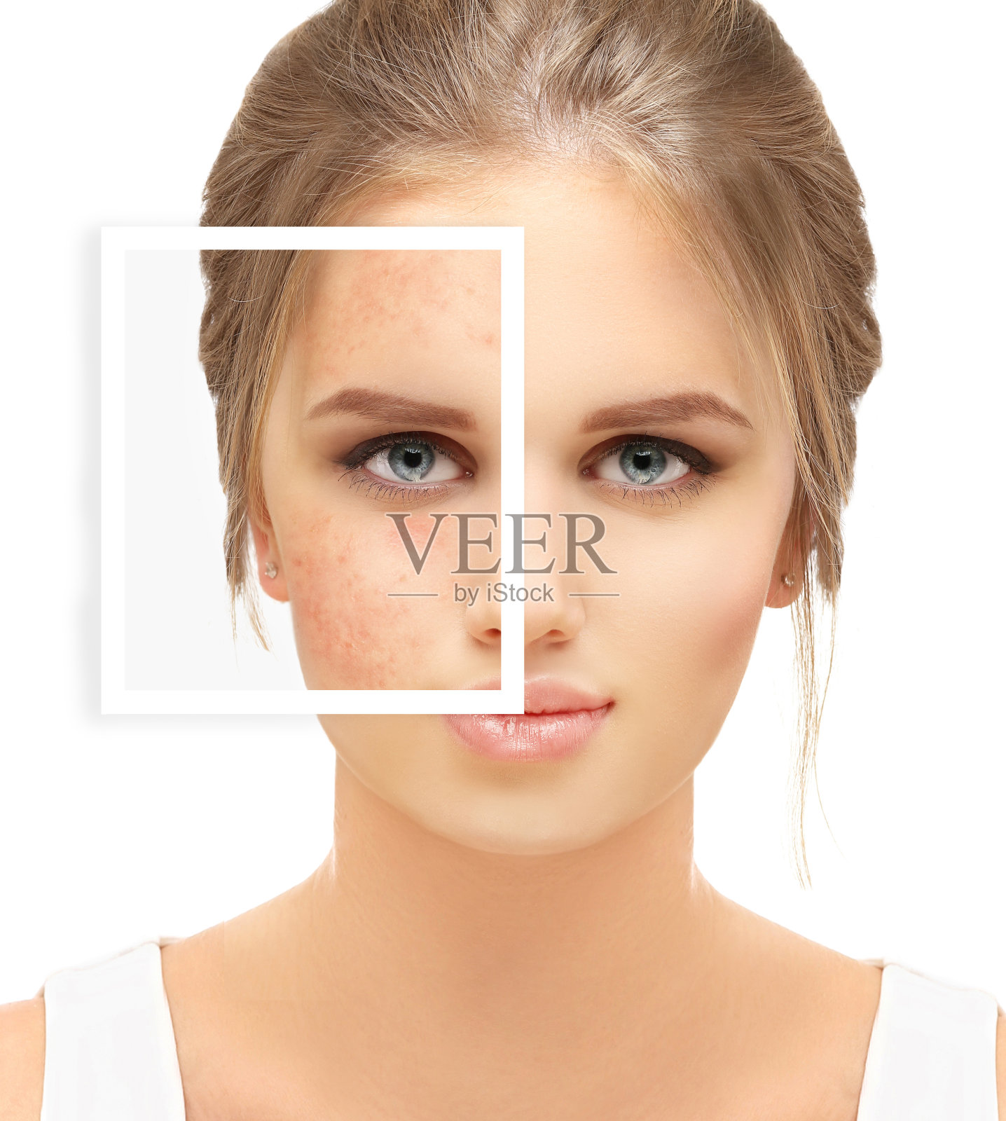 治疗痤疮疤痕。痤疮疤痕去除照片摄影图片