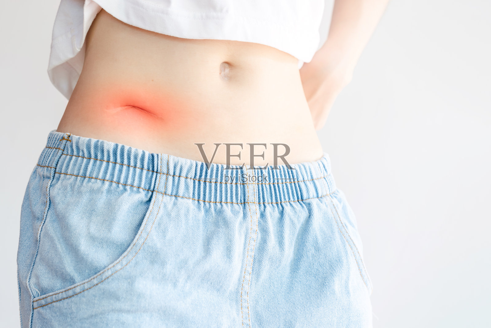 女性腹部手术引起的疤痕，如阑尾炎。医疗保健理念。照片摄影图片