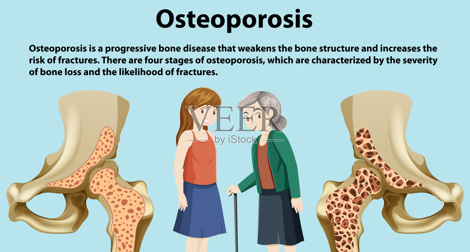 骨密度和骨质疏松矢量插画图片素材