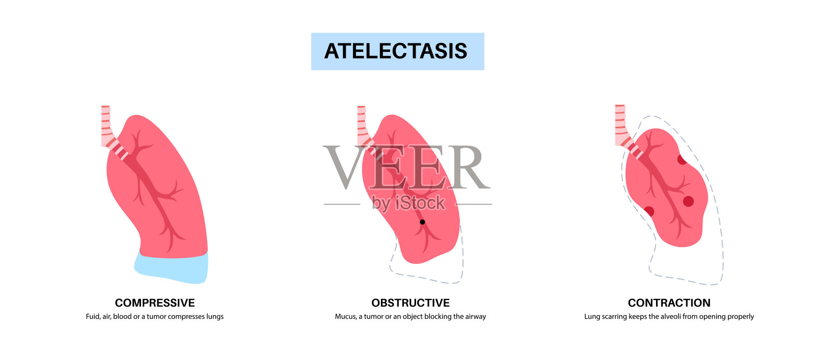 肺不张医学海报插画图片素材