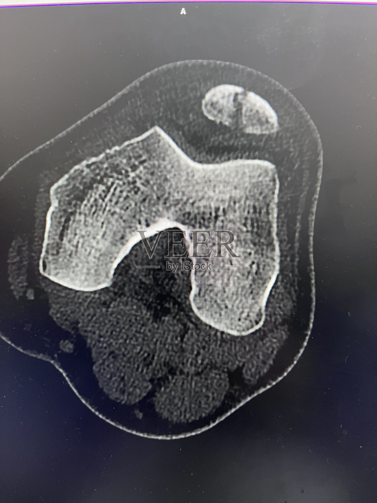 计算机断层扫描图像的病人髌骨骨折的结果是牛的膝盖在工作Konya土耳其2023照片摄影图片