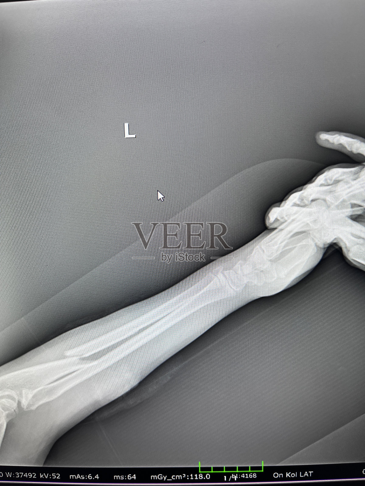 10岁女孩左臂尺骨近端骨折在公园玩耍时从高处坠落照片摄影图片