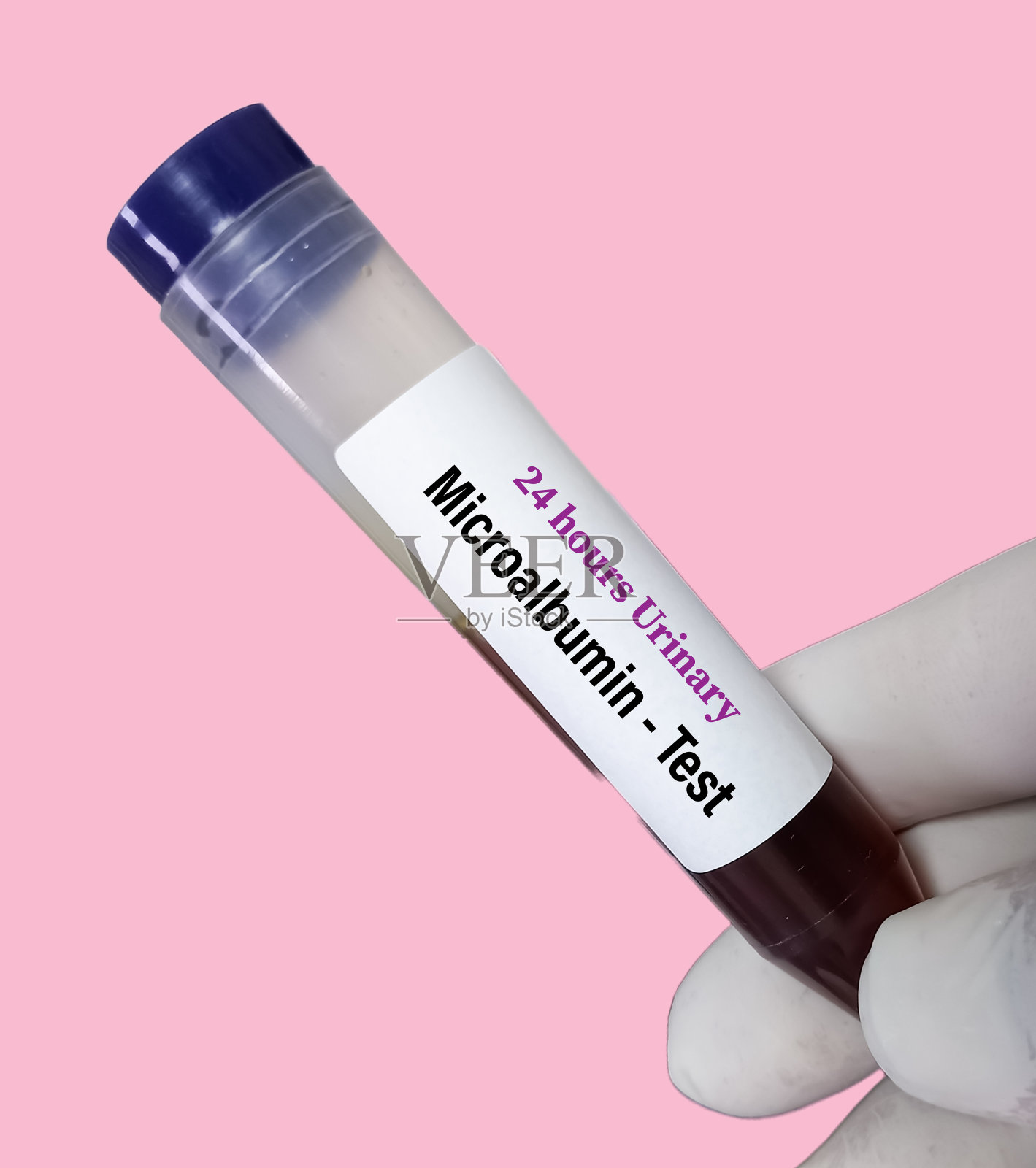 尿检24小时尿微量白蛋白对肾脏或肾脏疾病的诊断。照片摄影图片
