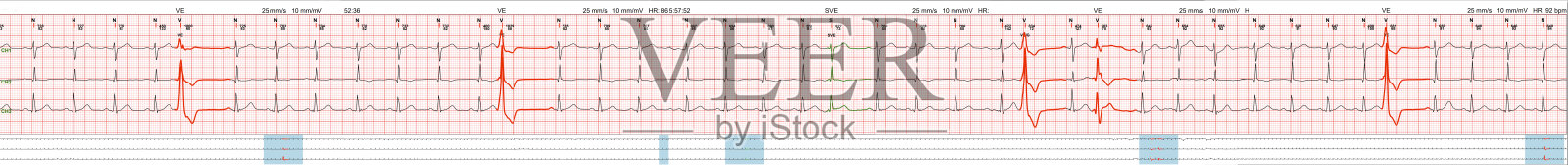 从病人的心波中绘制科学的心电图，在纸上绘制心电图照片摄影图片