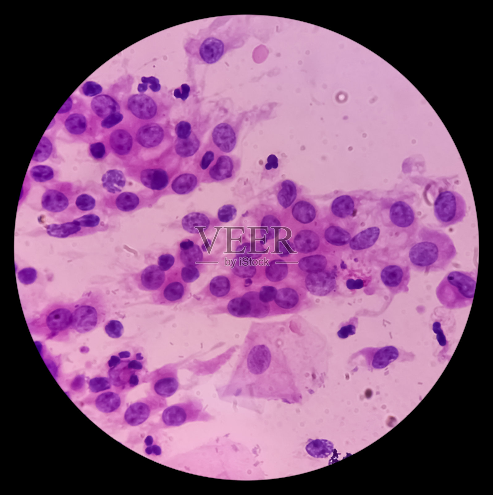 巴氏涂片。炎性涂片伴HPV相关改变。子宫颈癌。照片摄影图片