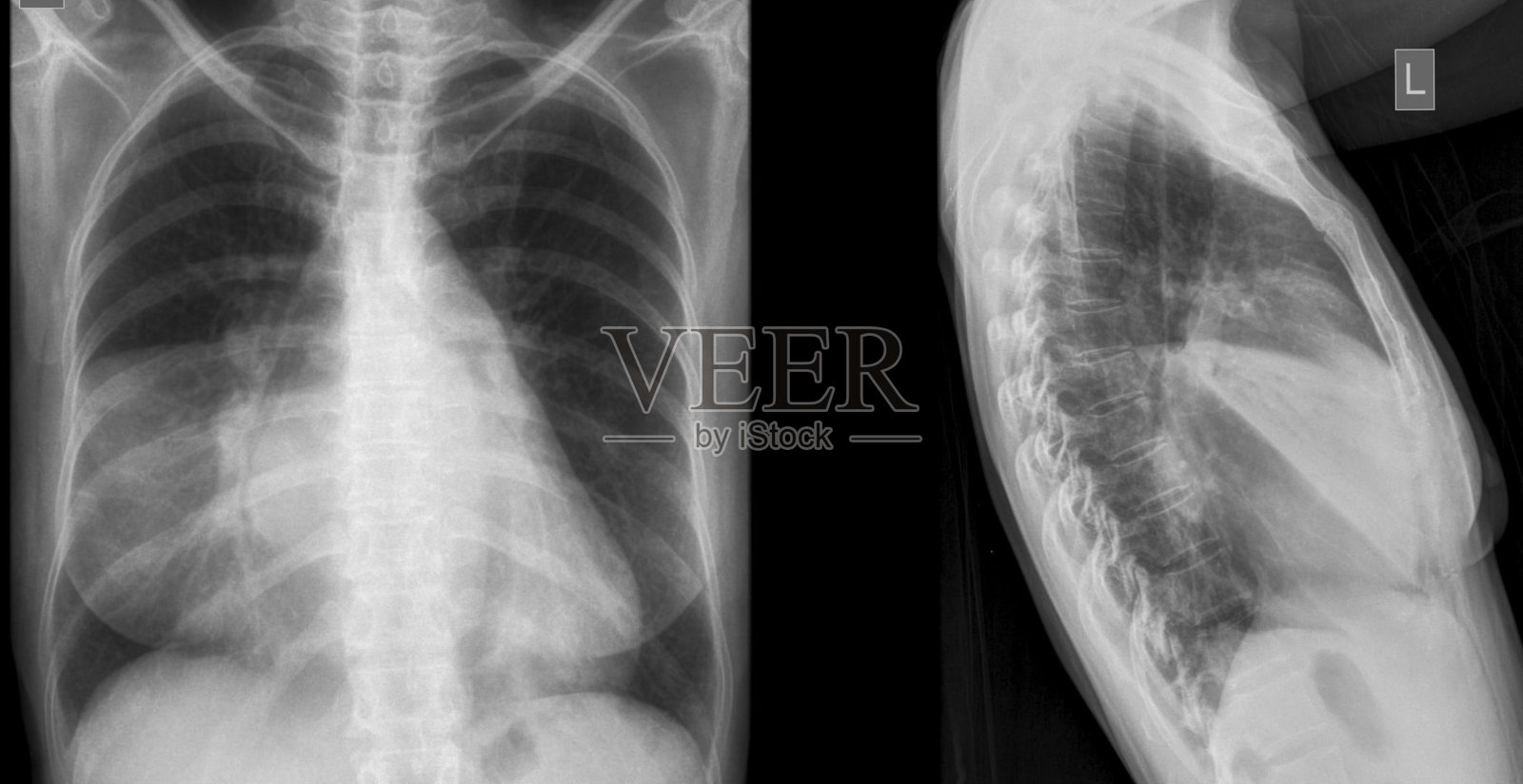 右中叶肺炎X光片照片摄影图片
