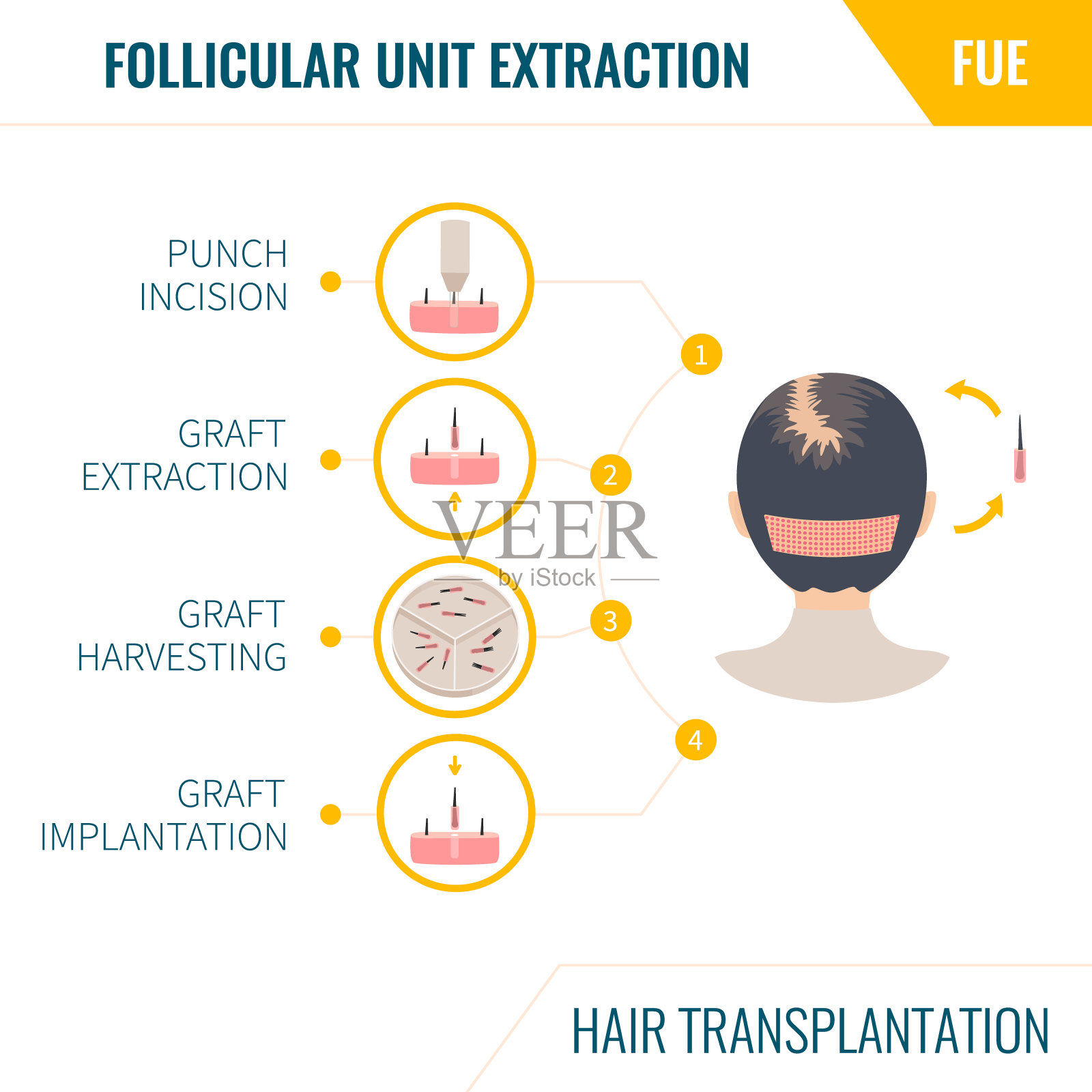 女性植发的FUE方法插画图片素材