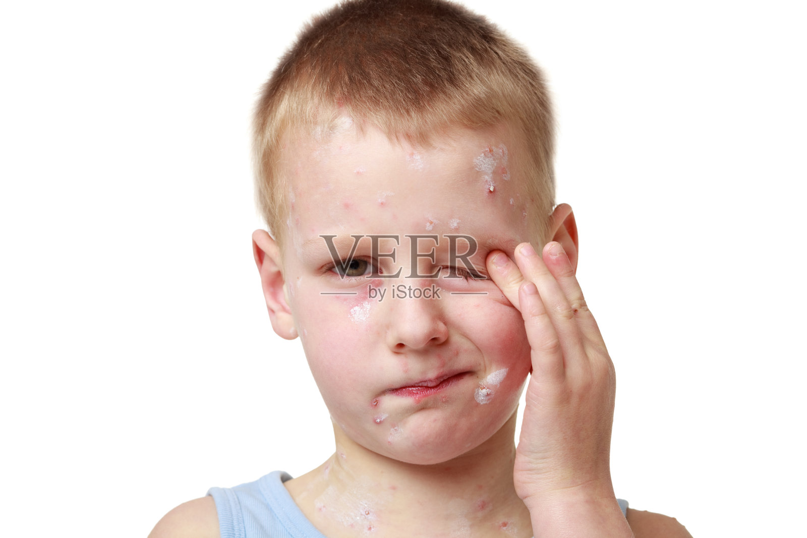 水痘照片摄影图片