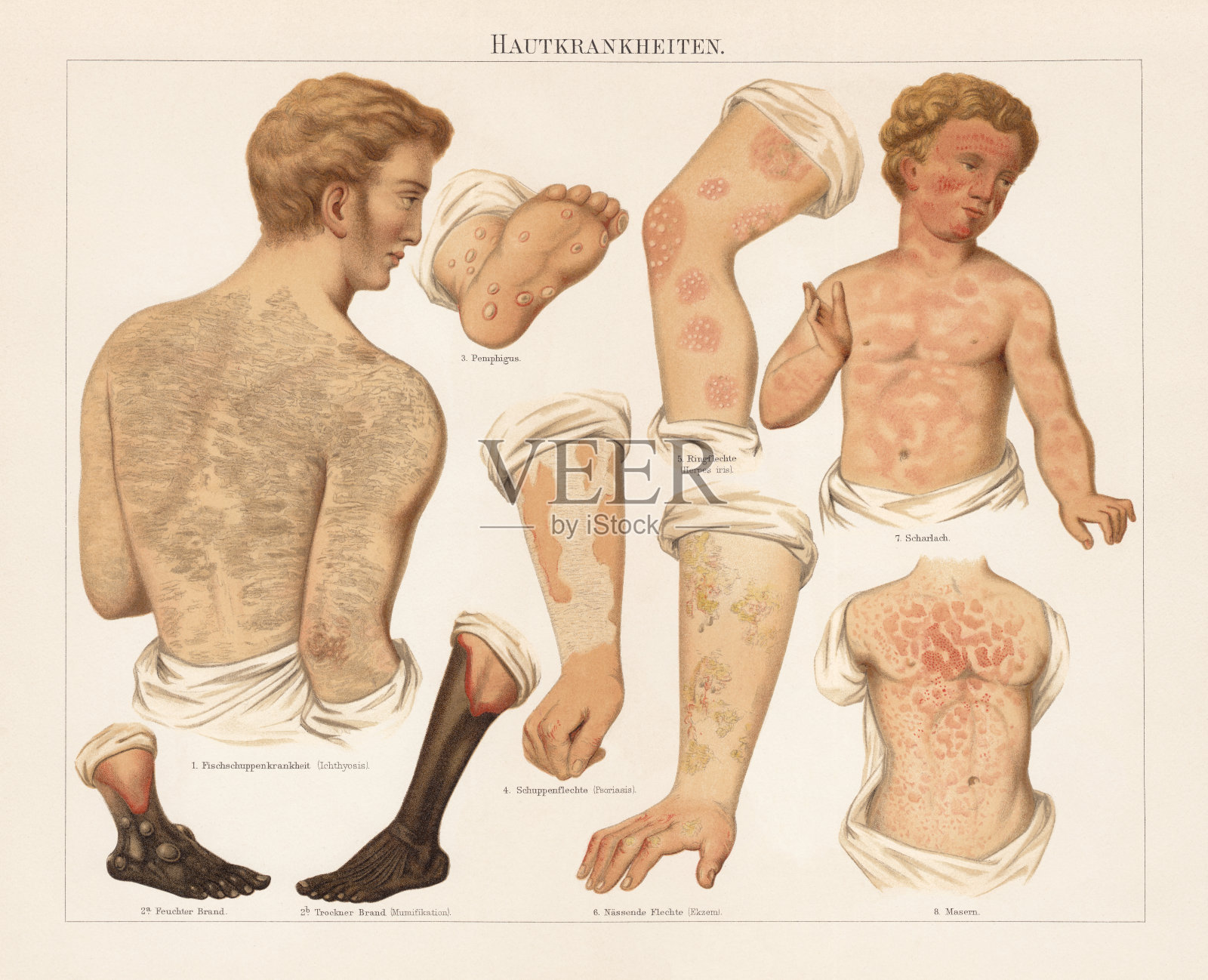 皮肤病，色谱仪，出版于1897年插画图片素材