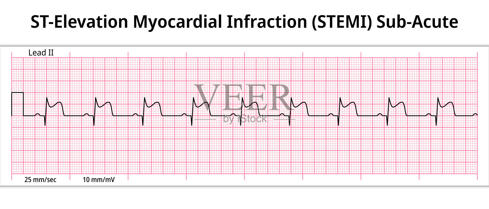 st段抬高型心肌梗死(STEMI)亚急性- 8秒心电图插画图片素材