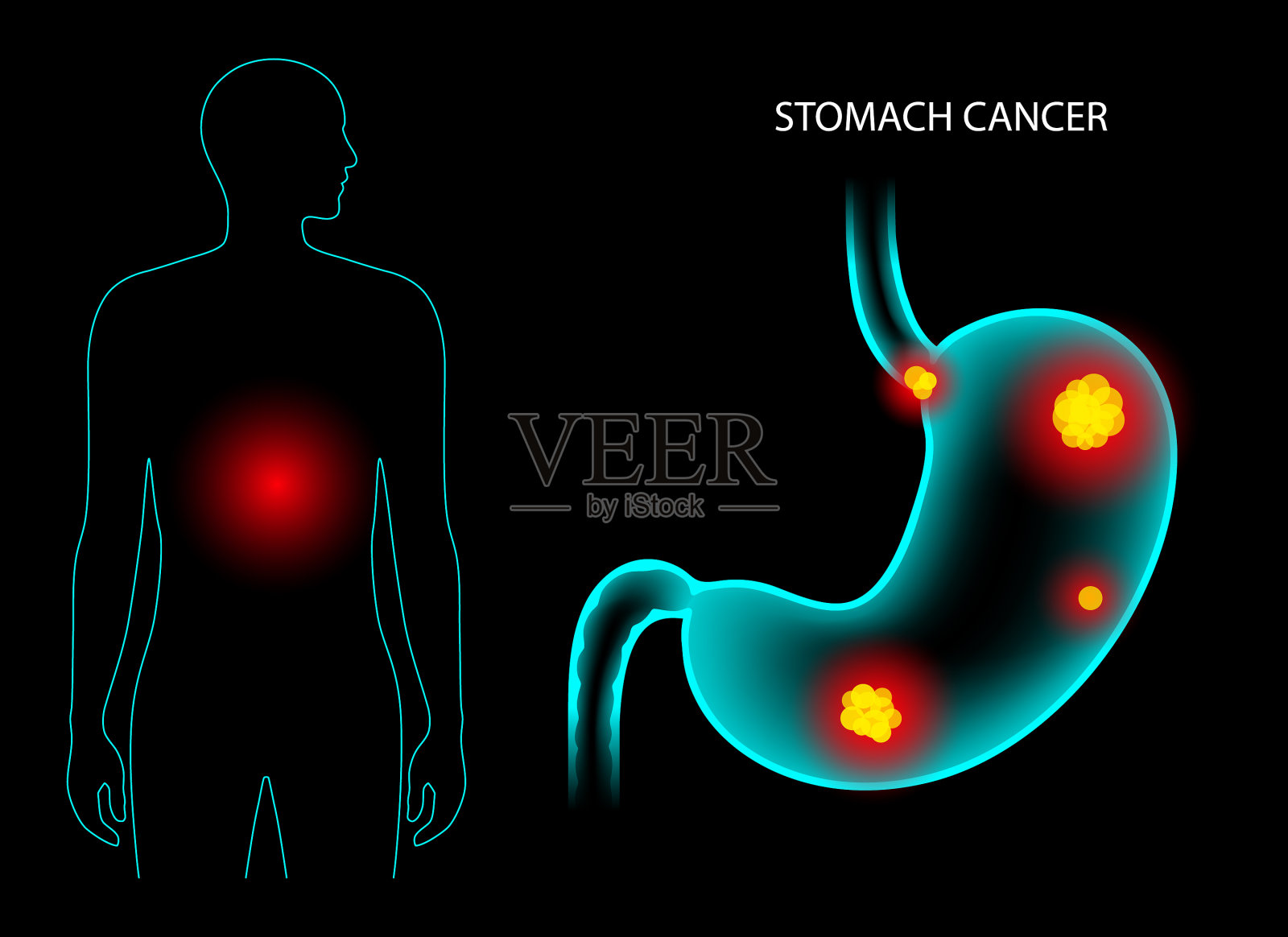 胃癌解剖学插画图片素材