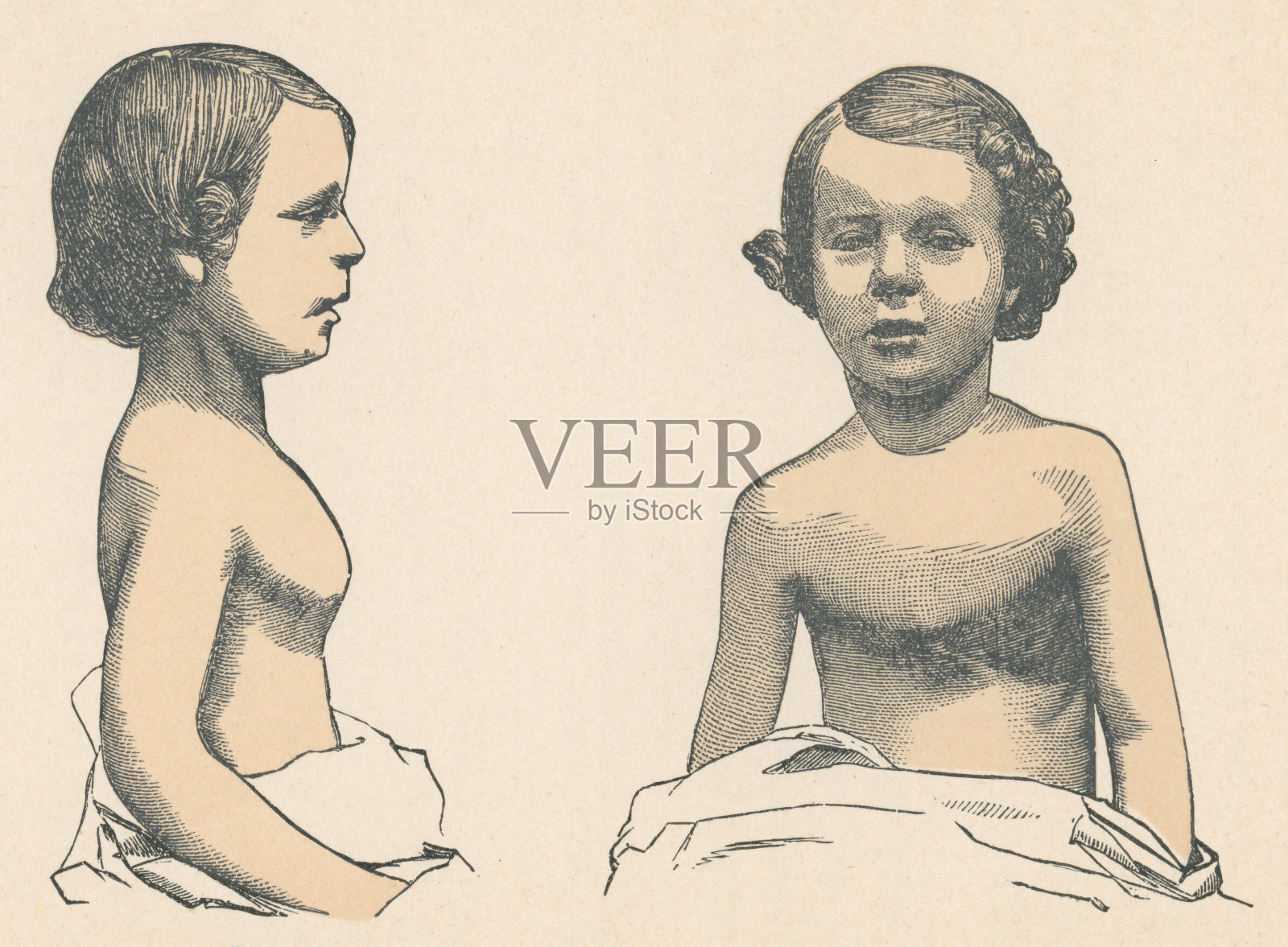 医学插图的一个男孩与胸隆- 19世纪插画图片素材