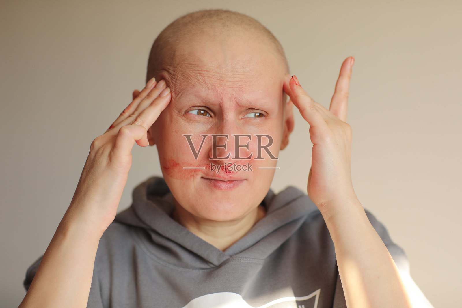 秃顶的癌症患者鼻子流血，这是化疗的影响。无毛癌症患者，头痛，用手摸头，鼻血多，脸上有红色的血照片摄影图片