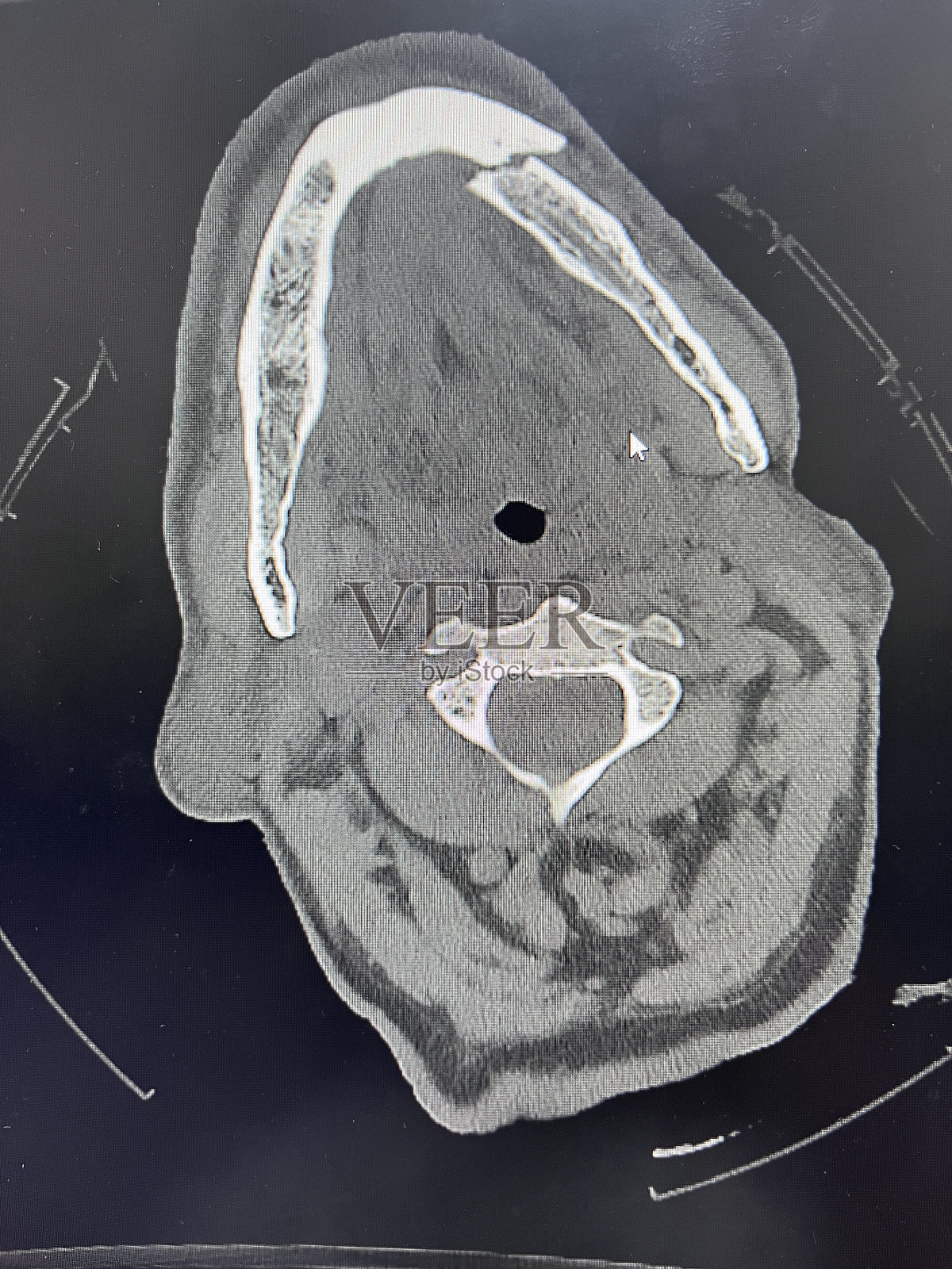 2023年在土耳其科尼亚，一名83岁的男性患者在驾驶拖拉机时与一辆卡车相撞，导致下颌骨骨折照片摄影图片