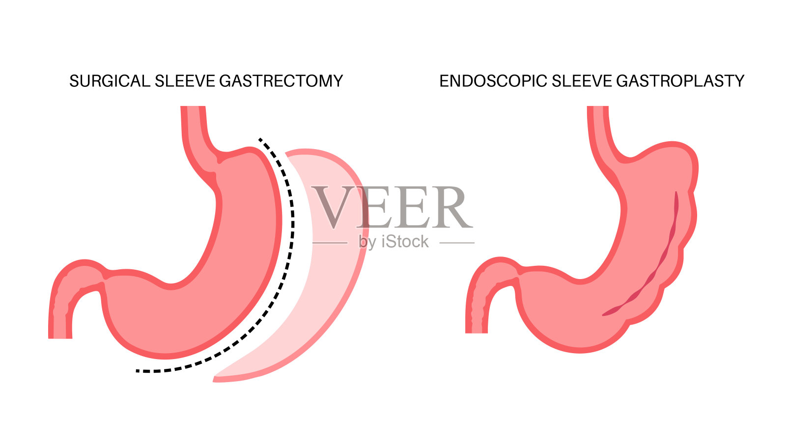 胃切除术和胃成形术插画图片素材