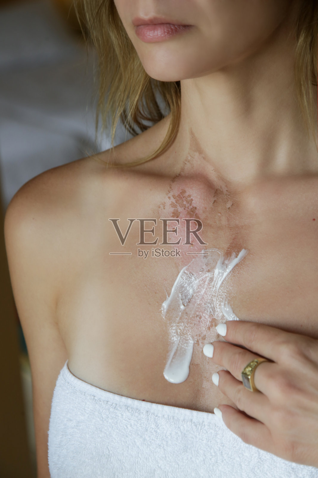 一位妇女在胸部烧伤的皮肤上涂抹药膏照片摄影图片