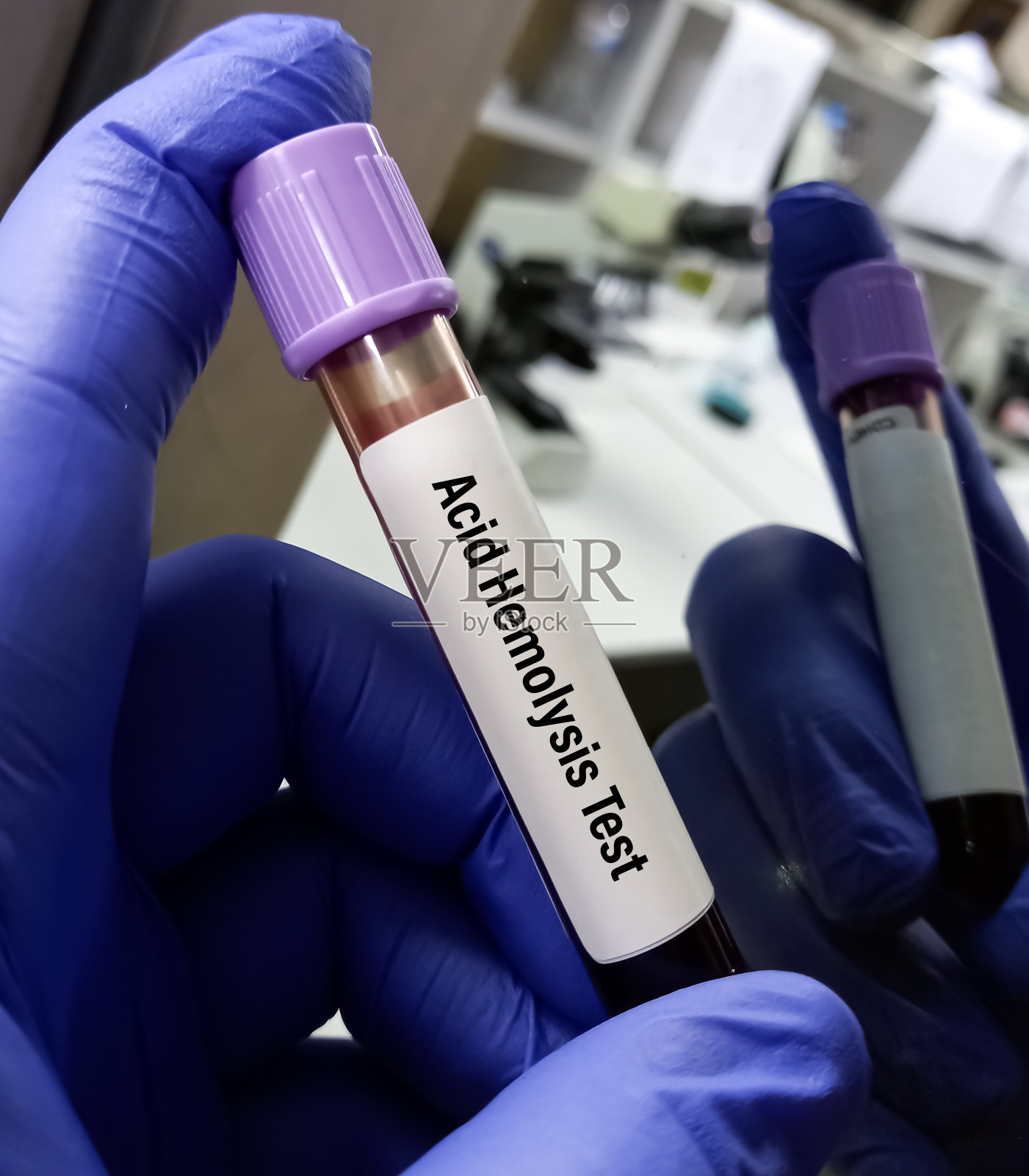 取血进行酸性溶血试验，诊断阵发性夜间血红蛋白尿(PNH)。火腿的测试。照片摄影图片