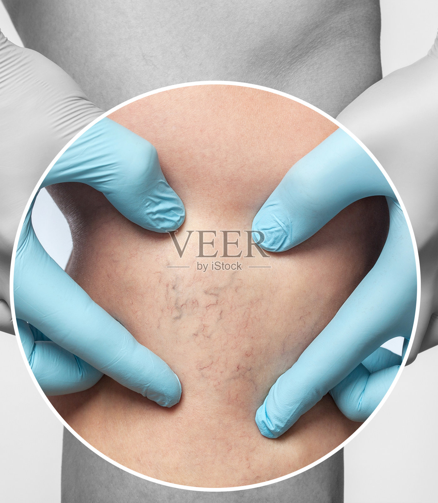 去除腿部静脉曲张。毛细血管扩张的医学检查和治疗。Phlebeurysm.sclerotherapy照片摄影图片