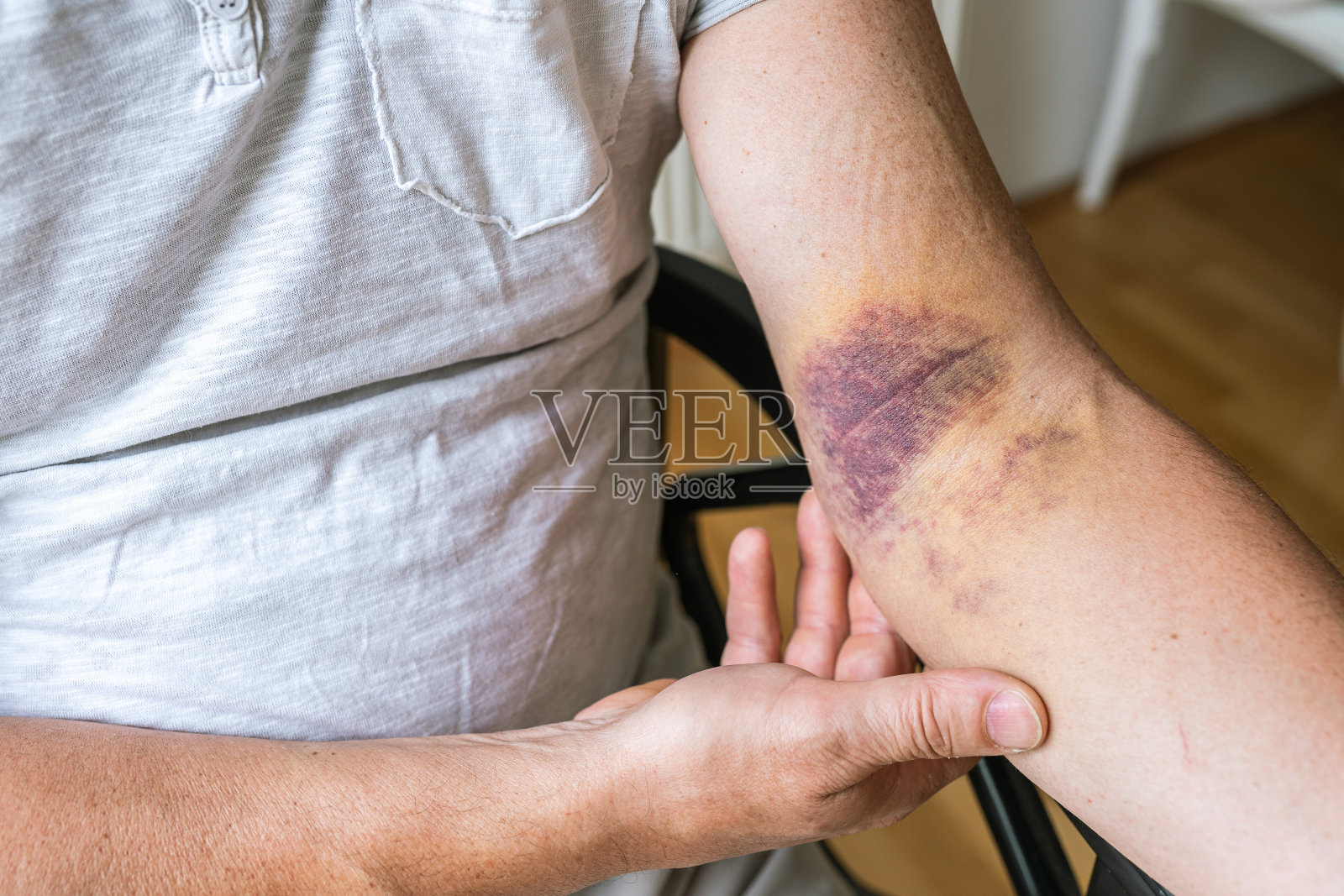 损伤韧带手臂擦伤照片摄影图片