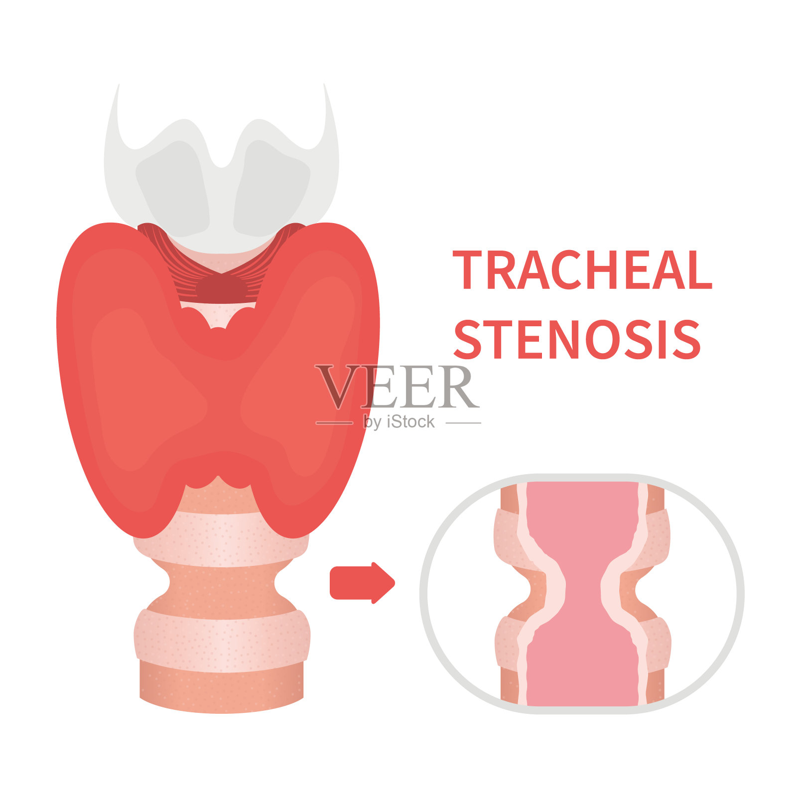 气管狭窄的意识图示插画图片素材