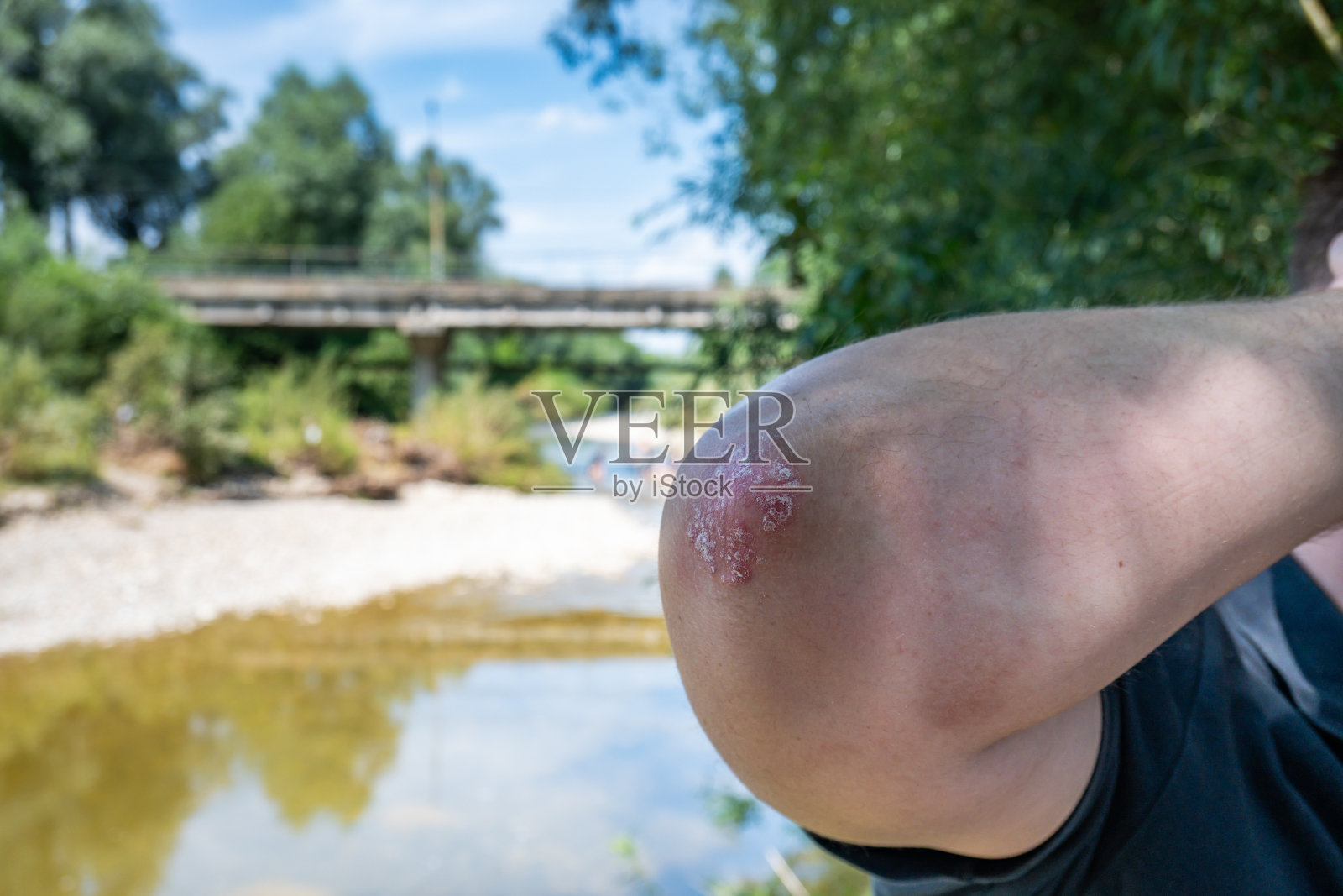 手臂皮肤干燥、片状的人，伴有牛皮癣、湿疹和其他皮肤病，如真菌、斑块、皮疹和瑕疵。照片摄影图片