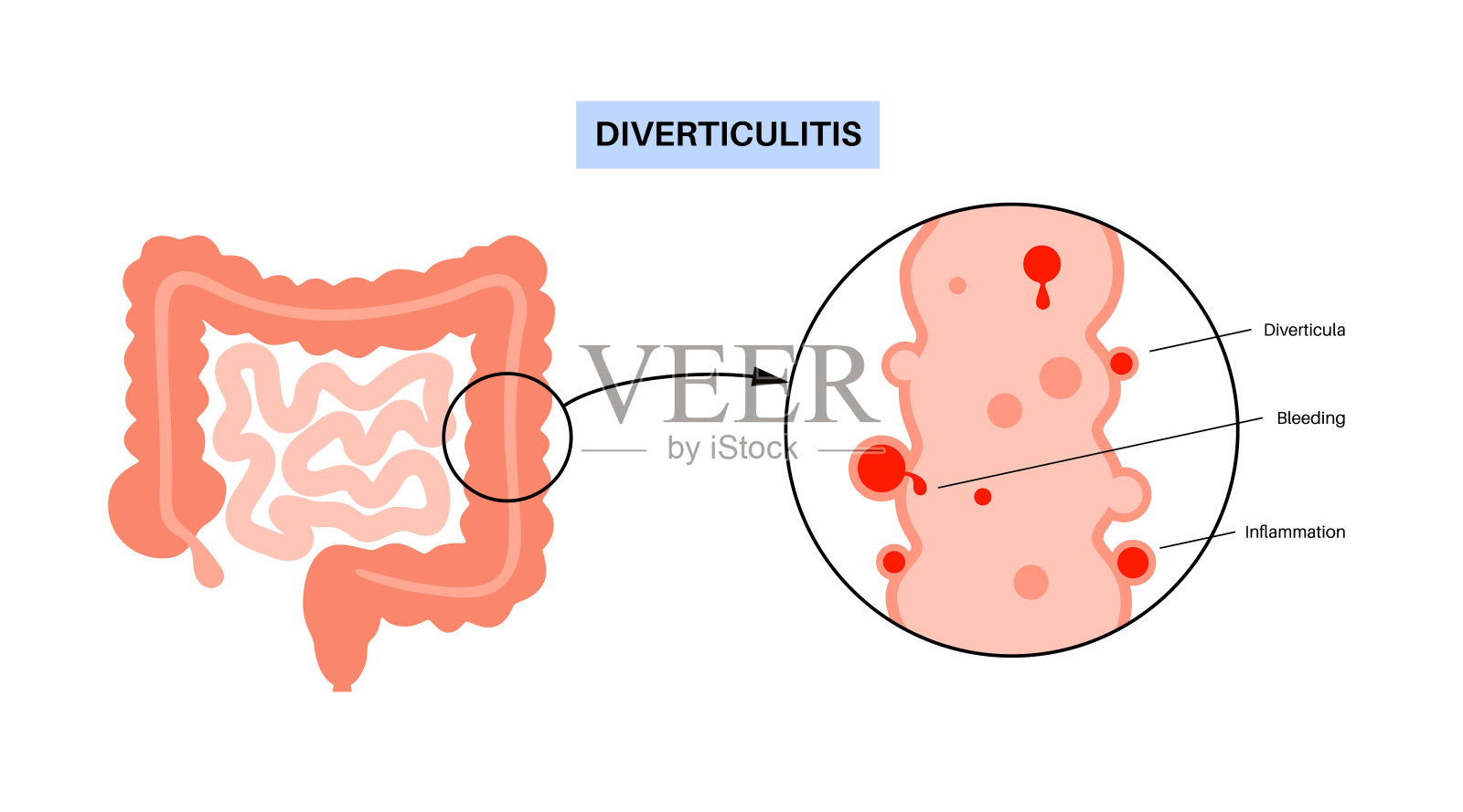 憩室炎和憩室病插画图片素材