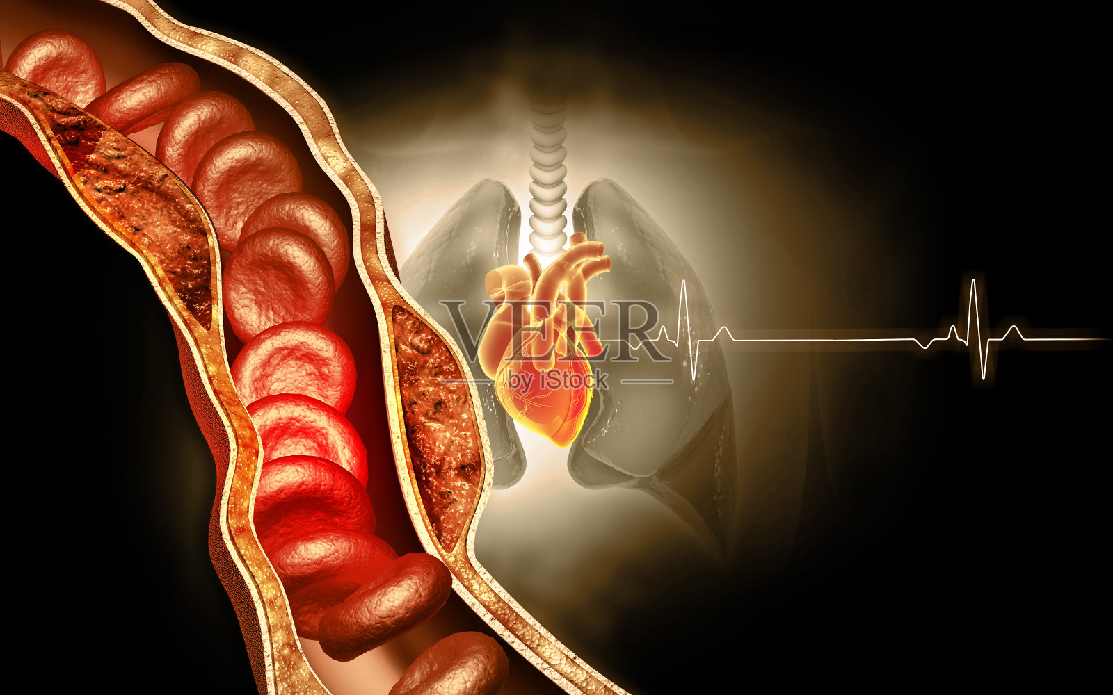 胆固醇在血管中的积聚三维演示照片摄影图片