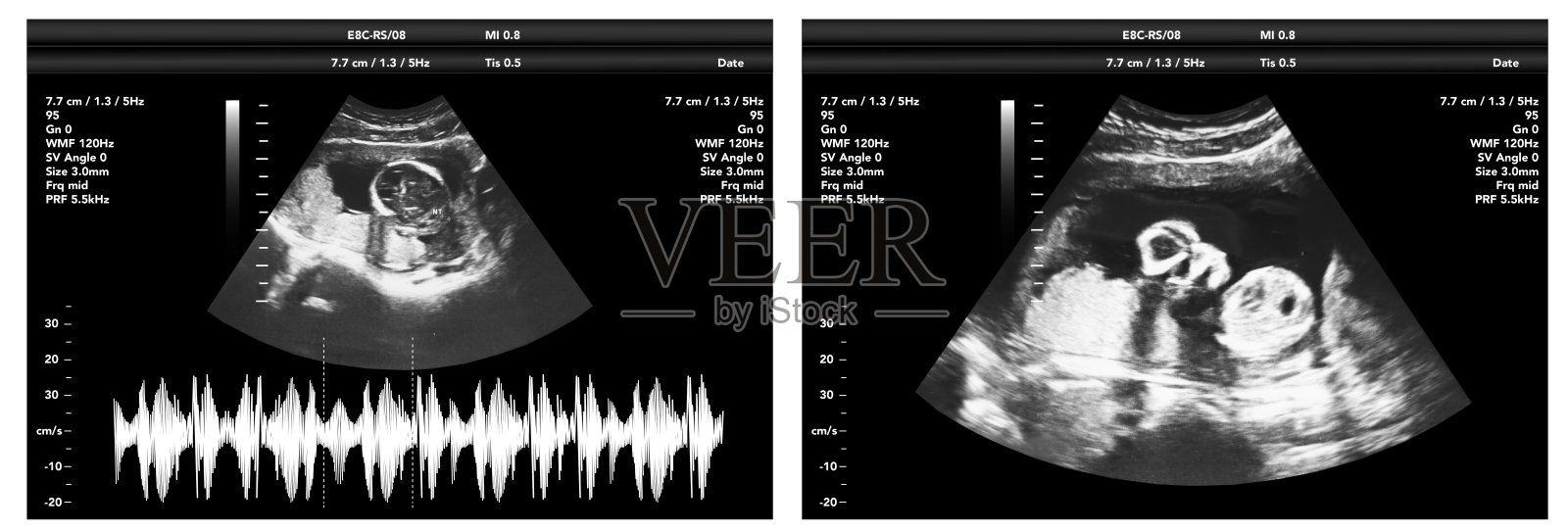 妊娠超声膜遗传生态学超声图，婴儿医学超扫描诊断控制插画图片素材
