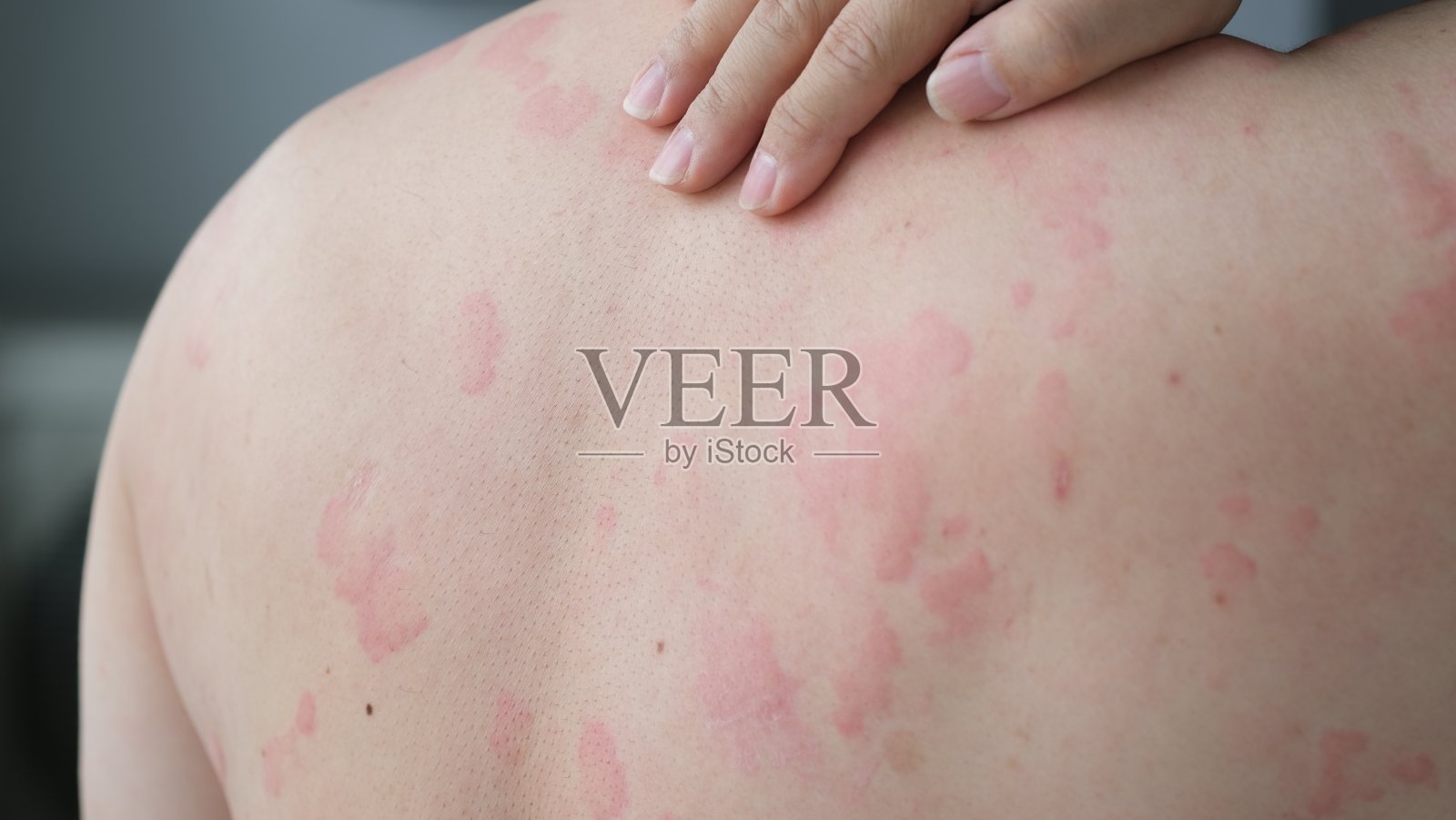 背部皮肤过敏引起荨麻疹照片摄影图片