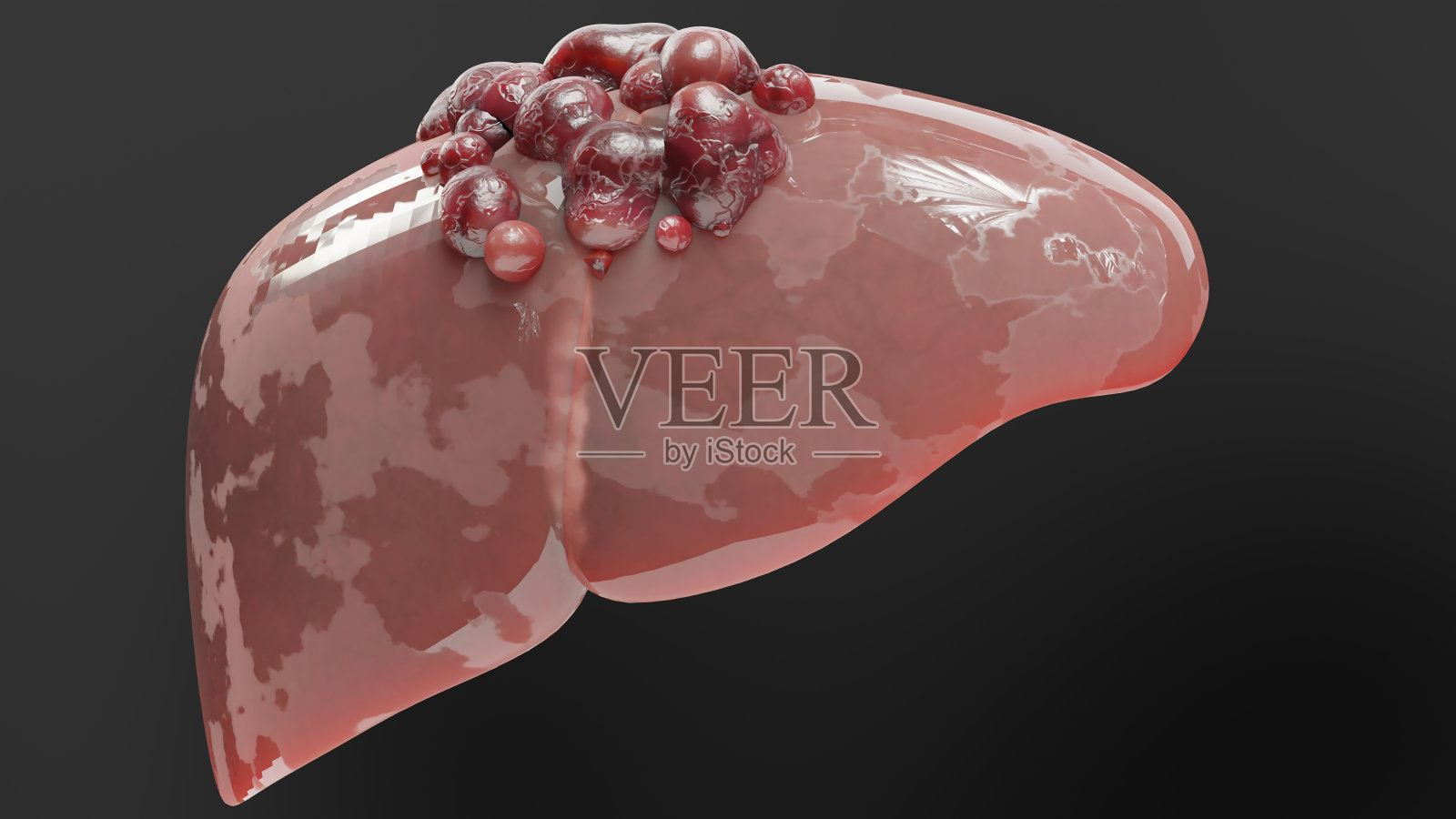 消化器官肝癌，肝炎肝硬化恶性肿瘤，肝功能衰竭，生长细胞，复制，纤维化，肝硬化，肝细胞癌，病毒感染肝脏，人类，3d渲染照片摄影图片