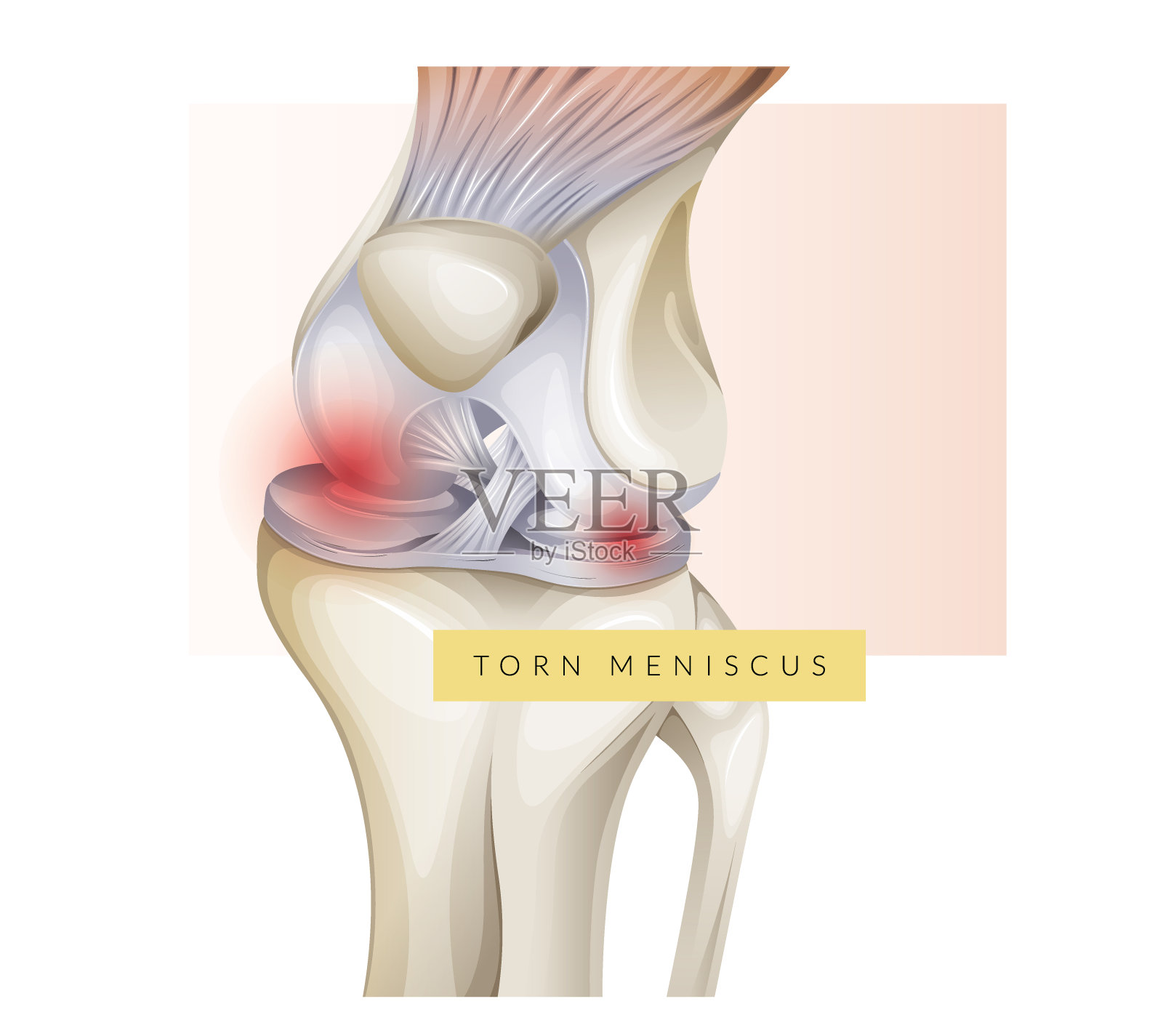 膝关节软骨损伤-半月板撕裂-图例插画图片素材