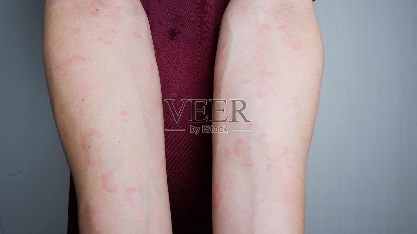 手臂遭受严重荨麻疹或荨麻疹或荨麻疹的特写图像。过敏症状。照片摄影图片